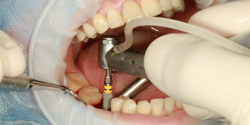 بهبودی دندان