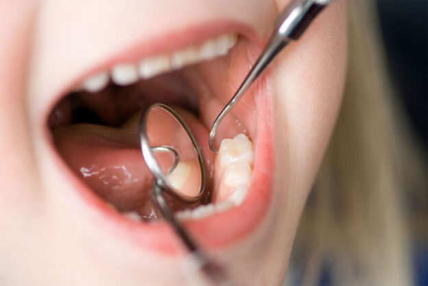 عوامل خطرناک پوسیدگی دندان