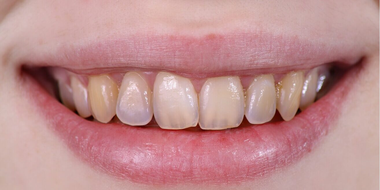 فرسودگی دندان