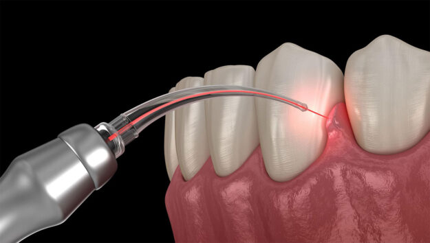 _LaserDentistry-min2 لیزر بافت نرم