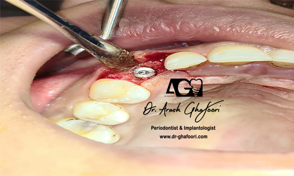 نکاتی در مورد کاشت ایمپلنت دندان بعد از شکست جراحی لیفت سینوس
