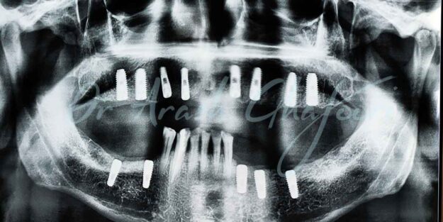 روش های مختلف کاشت ایمپلنت دندان