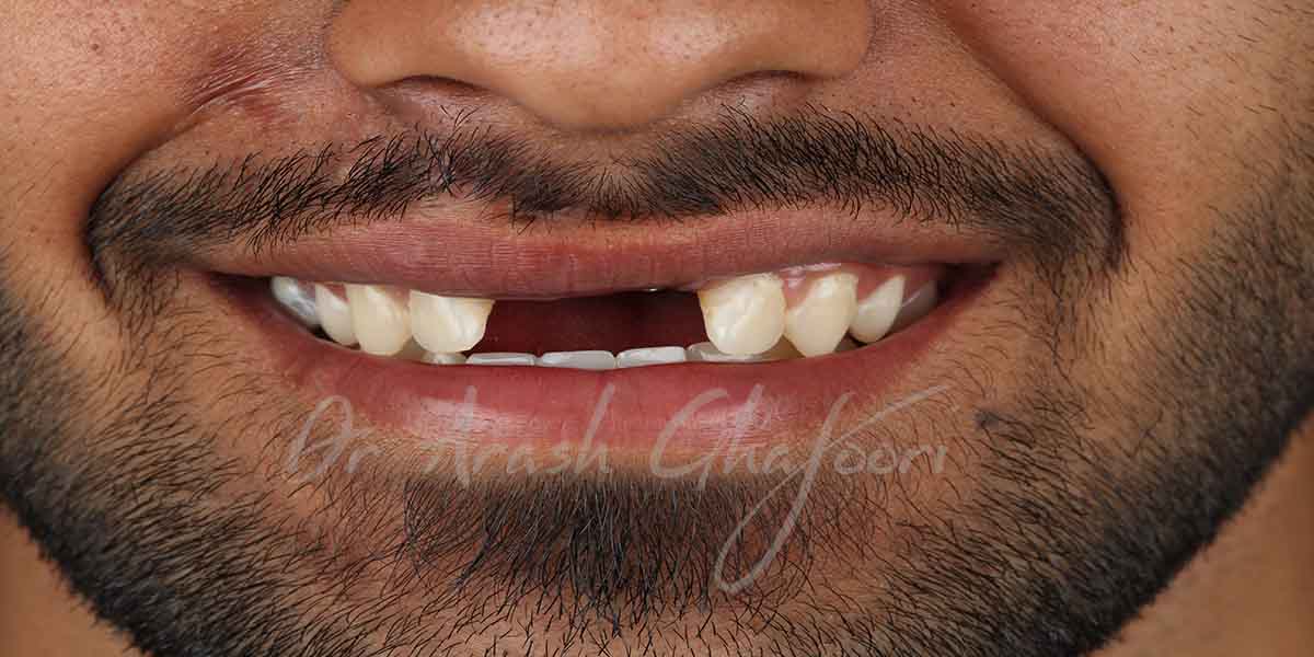 کاشت ایمپلنت دندان در ناحیه زیبایی و قدامی