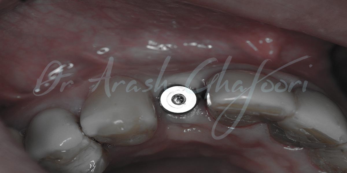 عفونت ایمپلنت دندان و درمان آن توسط دکتر آرش غفوری