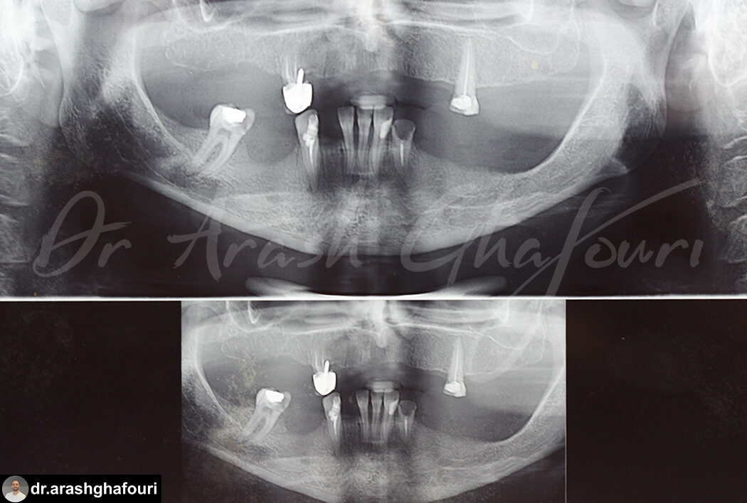بی دندانی کامل