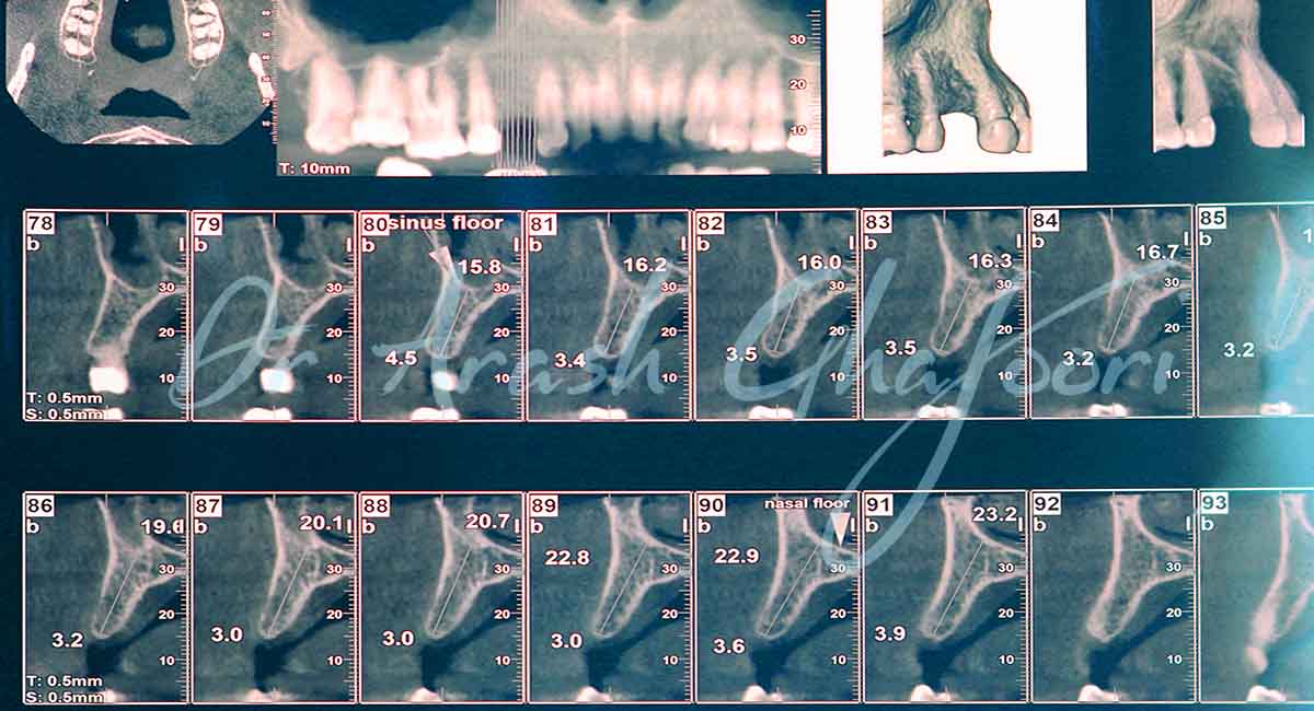 تکنولوژی در کاشت ایمپلنت دندان