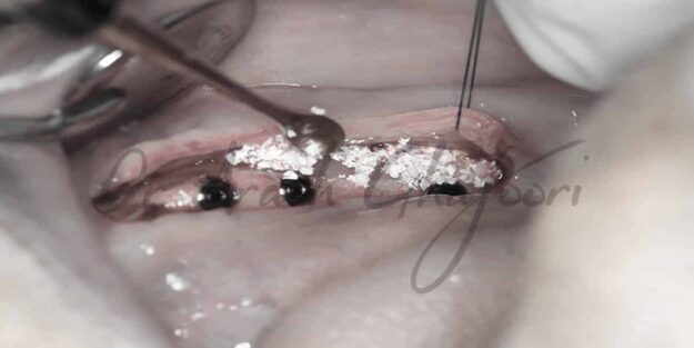 پیوند استخوان برای ایمپلنت دندان توسط دکتر آرش غفوری