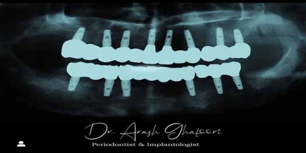 نمونه کار ایمپلنت دندان توسط دکتر آرش غفوری