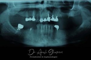 نمونه کار ایمپلنت دندان توسط دکتر آرش غفوری