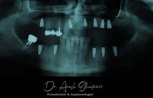 نمونه کار جراحی ایمپلنت دندان توسط دکتر آرش غفوری و کاشت 11 واحد ایمپلنت