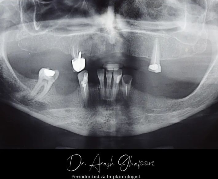 دندان های شکسته و تخریب شده قبل از کاشت ایمپلنت