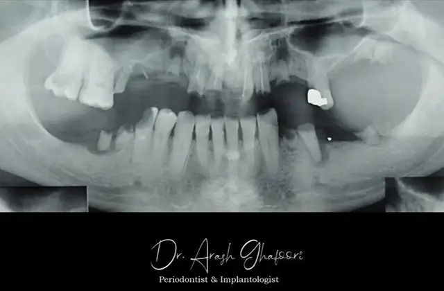 نمای قبل از کاشت ایمپلنت دندان