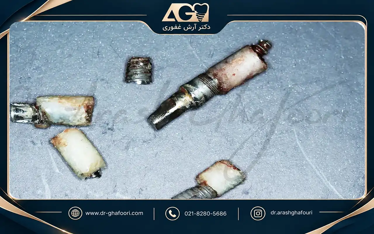 قبل از کاشت ایمپلنت دندان چه نکاتی را باید بدانید؟ ایمپلنت شکسته