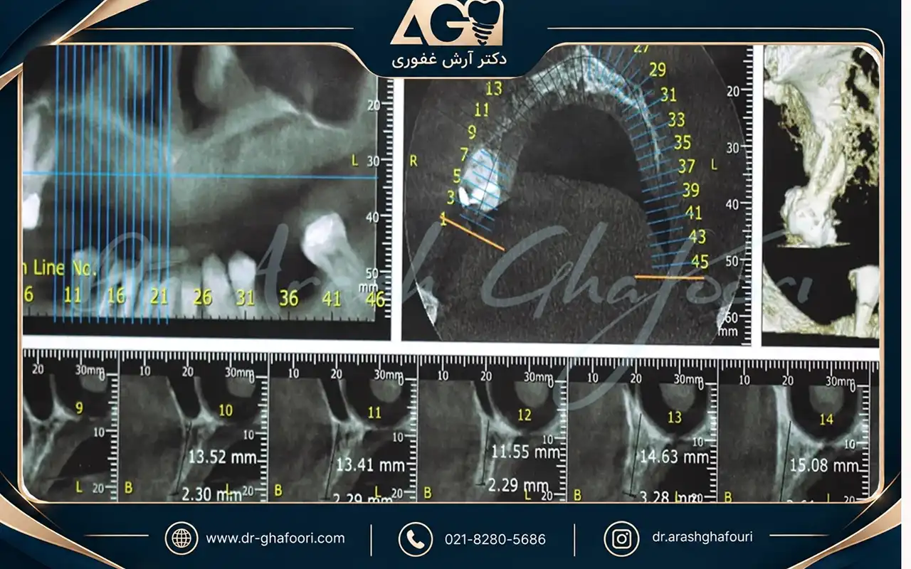 قبل از کاشت ایمپلنت دندان چه نکاتی را باید بدانید؟ عکس CBCT