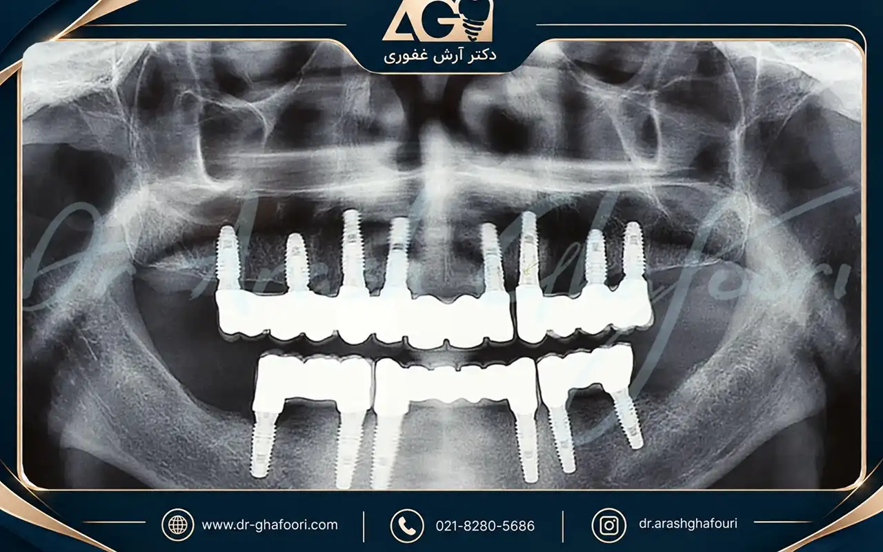 قبل از کاشت ایمپلنت دندان چه نکاتی را باید بدانید؟ عکس OPG