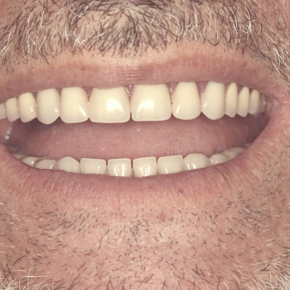 بازسازی دندان ها