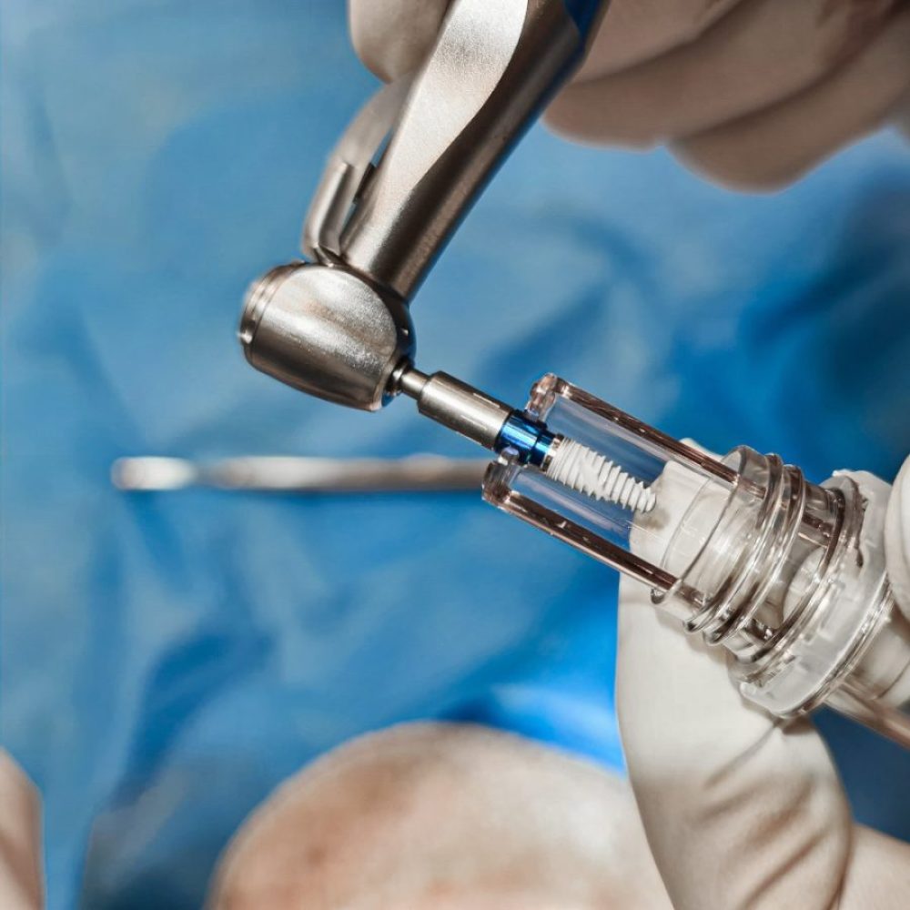 ایمپلنت دندان