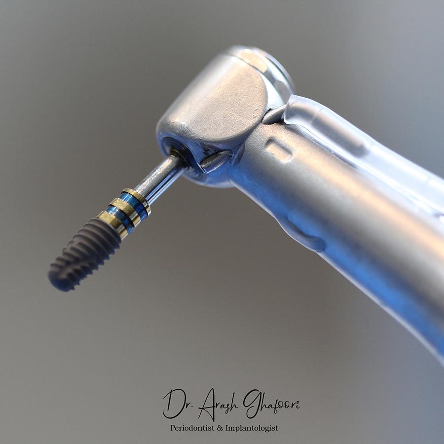 بهترین متخصص ایمپلنت در رشت و بهترین دکتر ایمپلنت در رشت دکتر آرش غفوری